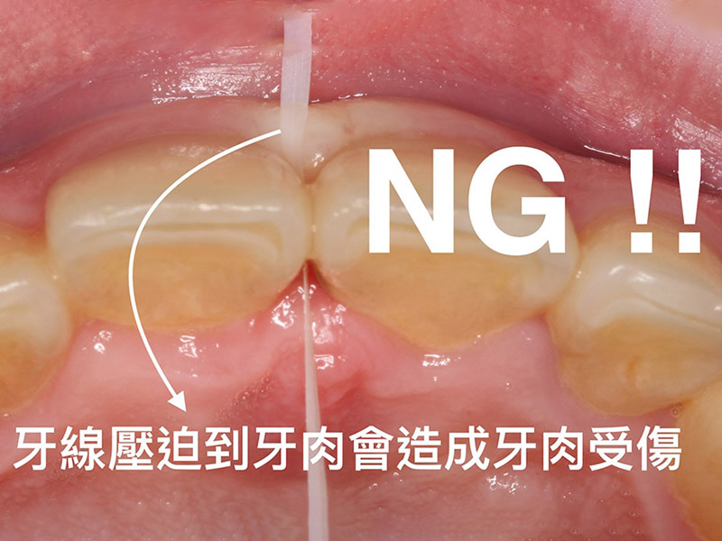 牙周病患者如何正確刷牙洗牙 5大牙齒保健工具挑選tips 葉立維醫師 牙周專科醫師 植牙專科醫師 桃園牙周病推薦首選