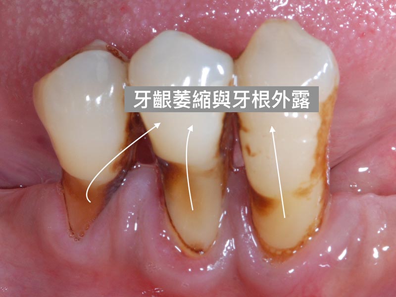 刷牙方式不當-牙齦萎縮-牙根外露-牙根敏感