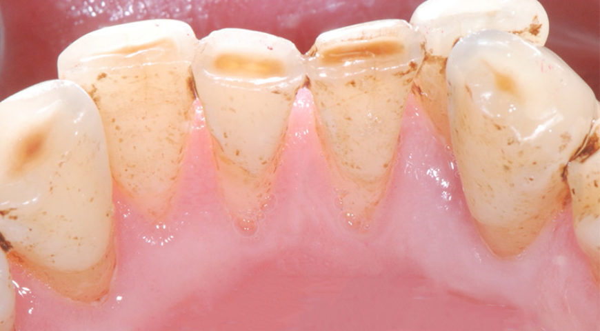 牙周病患者如何正確刷牙洗牙，5大牙齒保健工具挑選tips