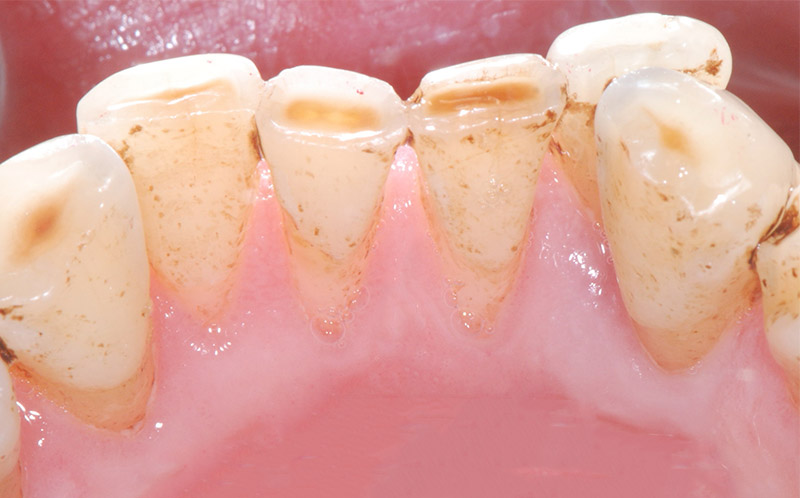 牙周病患者如何正確刷牙洗牙，5大牙齒保健工具挑選tips