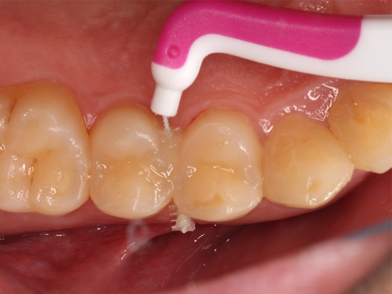 洗牙-刷牙-牙齒保健-牙刷-漱口水-牙間刷使用方式，從舌側往頰側清潔會更徹底