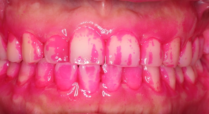 牙周病-牙周病治療-牙周專科醫師-桃園當代牙醫植牙中心-葉立維醫師-使用牙菌斑顯示劑才能完整確認潔牙狀況