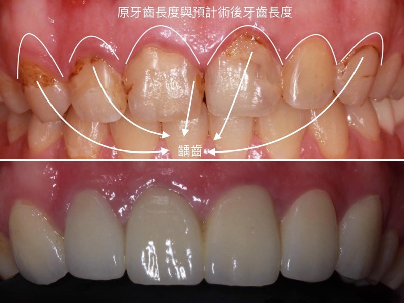 牙冠增長術-牙齦手術-術前術後比較圖-牙周整形手術-葉立維醫師-桃園