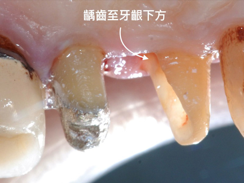 牙周病治療-牙周病手術-牙冠增長術-牙周專科醫師-桃園當代牙醫-葉立維醫師-牙冠增長術前齲齒已深入到牙齦下方-1