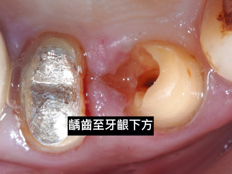 牙周病治療-牙周病手術-牙冠增長術-牙周專科醫師-桃園當代牙醫-葉立維醫師-牙冠增長術前齲齒已深入到牙齦下方-2