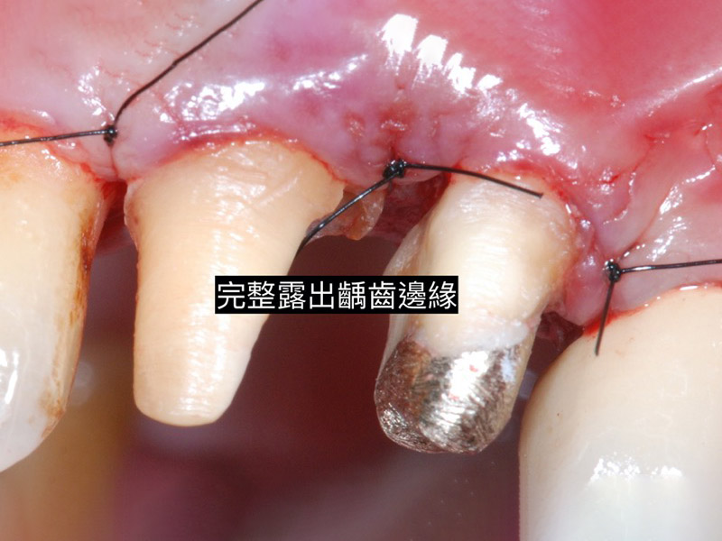 牙周病治療-牙周病手術-牙冠增長術-牙周專科醫師-桃園當代牙醫-葉立維醫師-牙冠增長術後，已完整露出齲齒邊緣