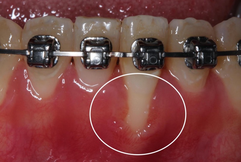 牙根覆蓋術-手術前-牙根外露-牙齦萎縮-角化牙齦不足-葉立維醫師-桃園