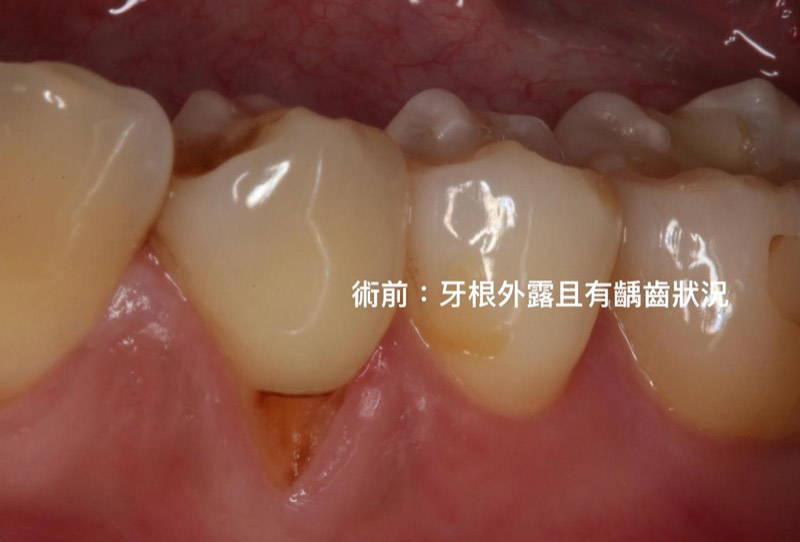牙根覆蓋術-牙根外露-手術前-葉立維醫師-桃園