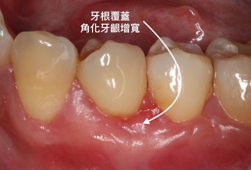 牙根覆蓋術-牙根外露-手術後-角化牙齦增寬-葉立維醫師-桃園