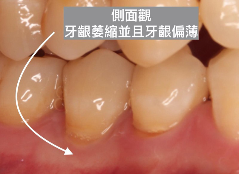 裂耗-牙齦萎縮-牙齦偏薄-葉立維醫師-桃園