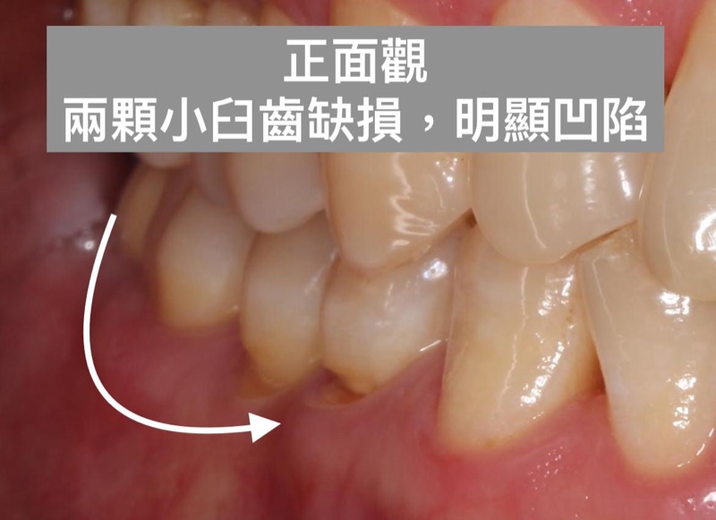 裂耗-牙齦凹槽-牙齒斷裂-葉立維醫師-桃園