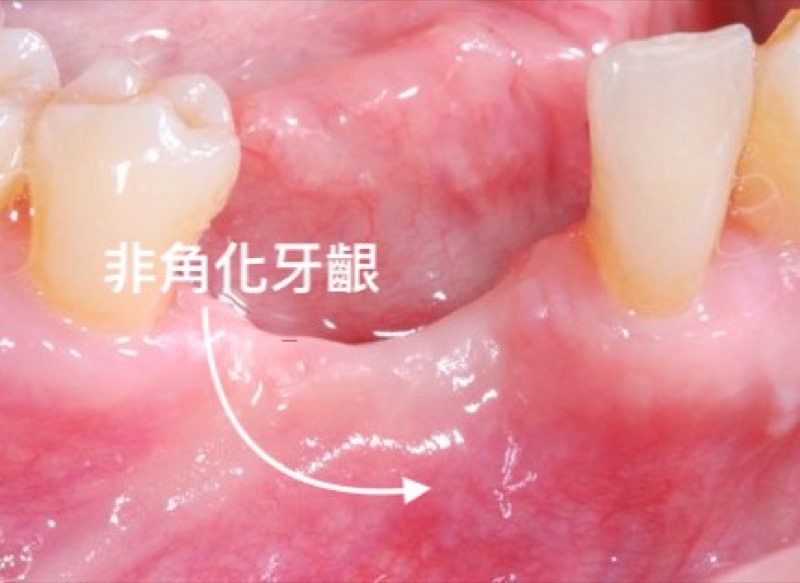 非角化牙齦-位置-口腔示意圖-葉立維醫師-桃園