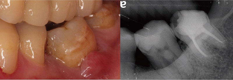 牙周病治療前-左下臼齒-牙齦紅腫-大範圍填補痕跡-牙髓-牙周問題