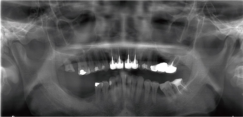牙周病治療案例-環口式X光片-全口牙周病