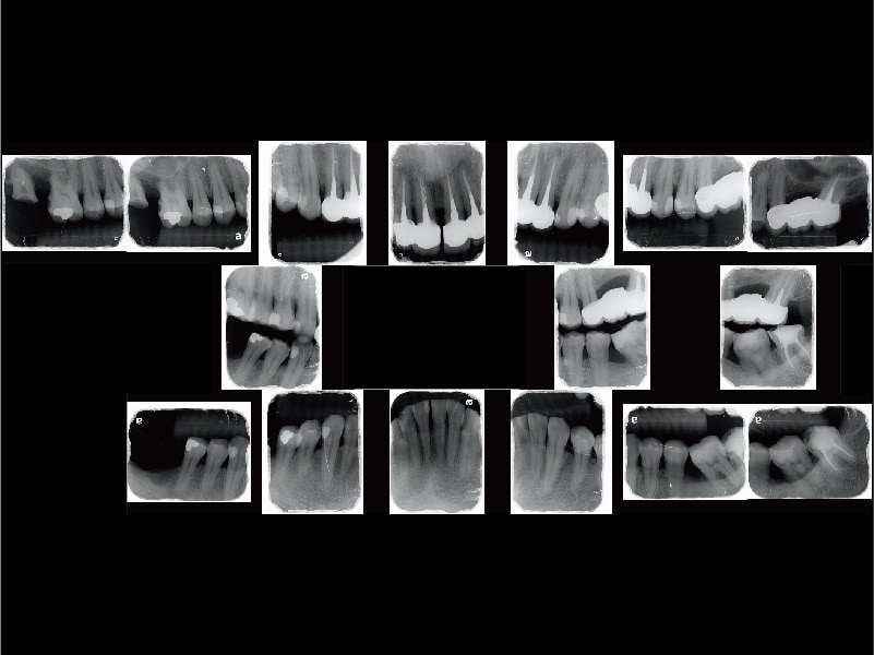 牙周病治療案例-全口X光片-嚴重牙周病