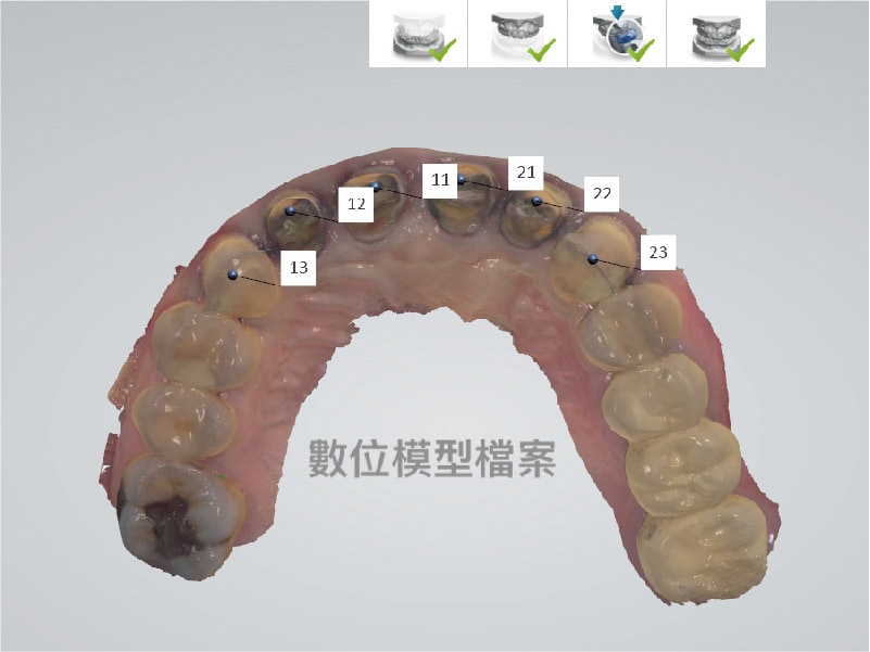 DSD數位微笑設計-上顎齒列數位虛擬模型