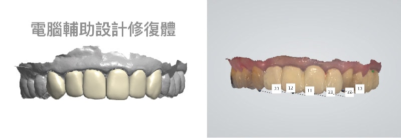 DSD數位微笑設計-電腦輔助設計模擬-前牙美觀區