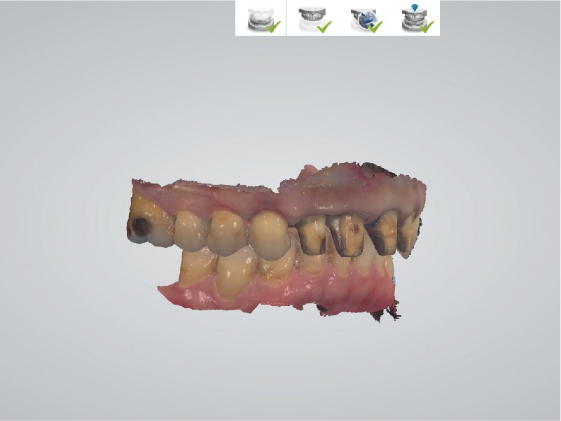 DSD數位微笑設計-右側咬合數位虛擬模型