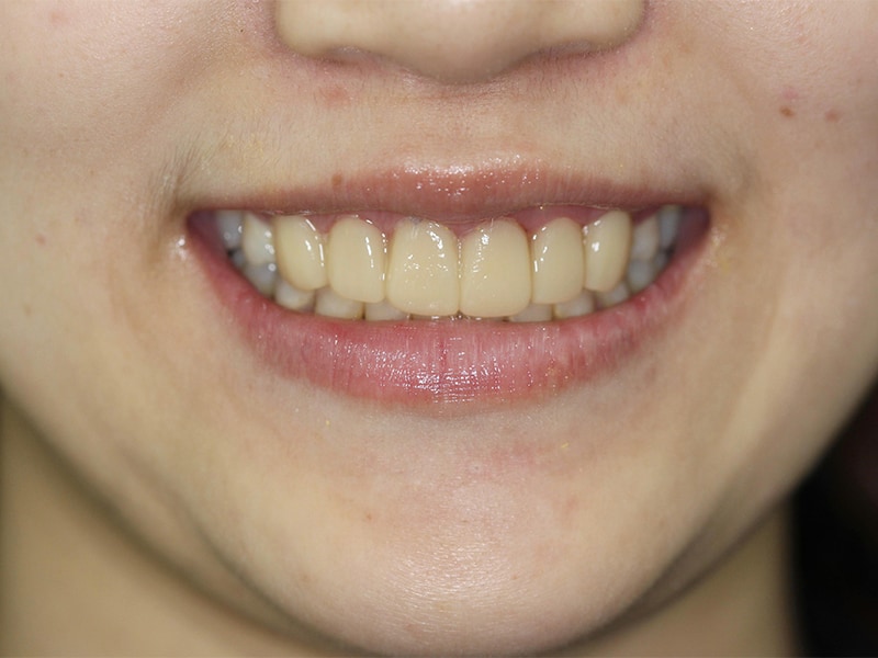牙冠增長術推薦-DSD數位微笑設計-試戴笑容-臨時貼片
