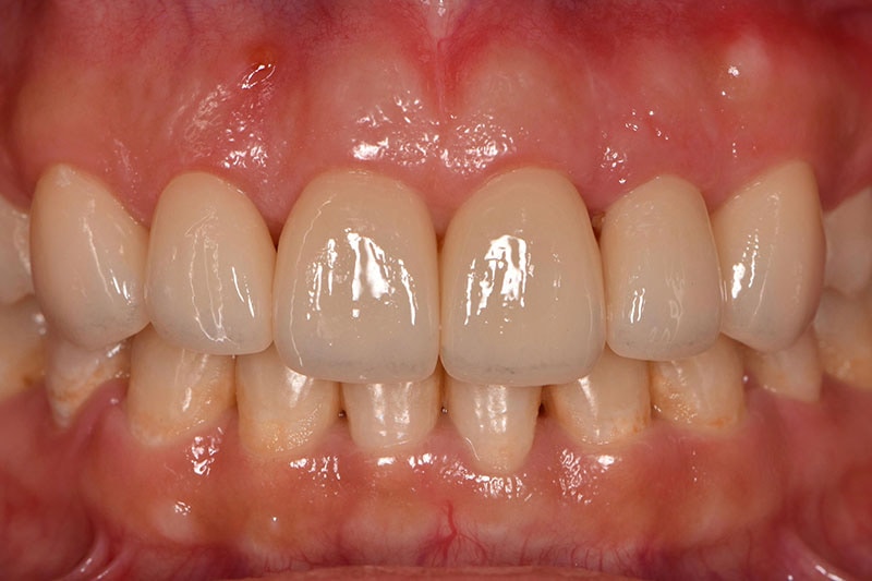 笑露牙齦-牙縫大-牙冠增長術-全瓷貼片-Miss-Wu全新升級的前牙美觀區
