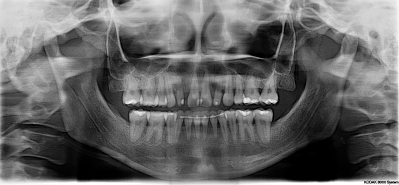 環口全景X光片-蛀牙-補牙變色-牙縫大