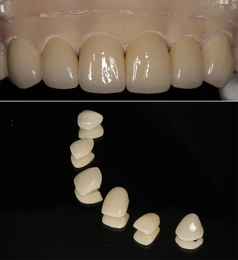 笑露牙齦-牙縫大-牙冠增長術-全瓷貼片-六顆全瓷貼片和3D數位模型上的模擬成品