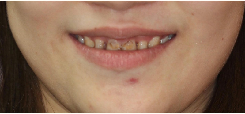 牙冠增長術-手術前-笑露牙齦-牙縫大-牙齦發炎-釘狀齒