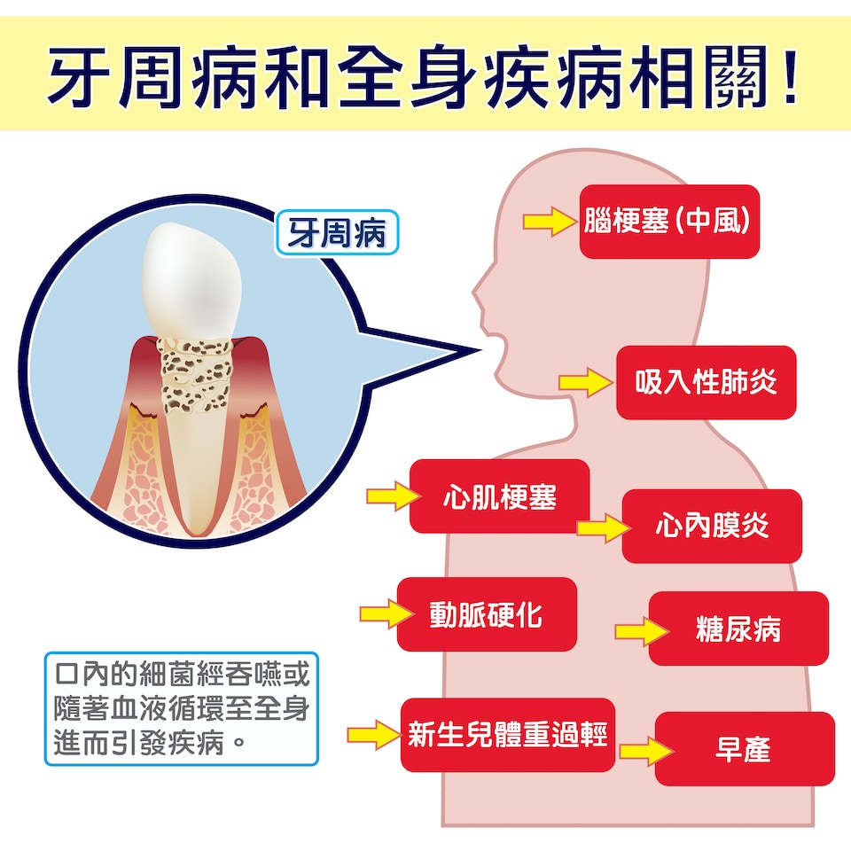 牙周病莫輕忽，不及早治療恐影響全身健康！ - 葉立維醫師 - 牙周專科醫師