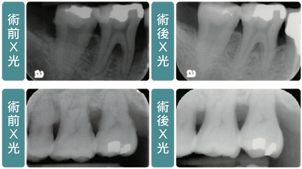 牙周病手術 葉立維醫師 牙周專科 植牙專科醫師 桃園牙周病推薦首選