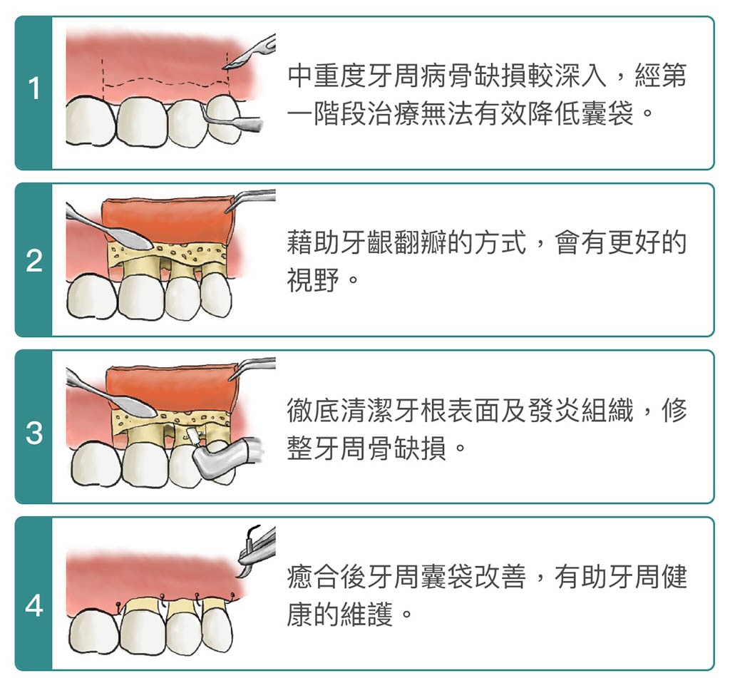 牙周病手術 葉立維醫師 牙周專科 植牙專科醫師 桃園牙周病推薦首選