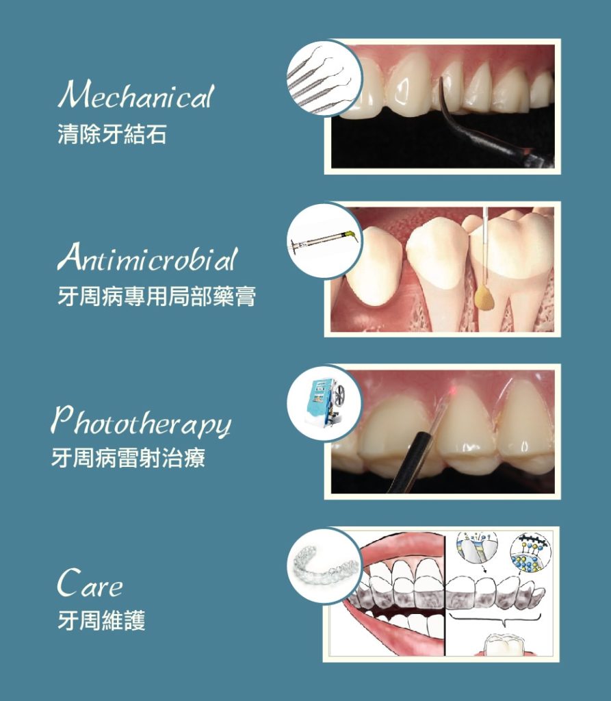 MAPCare牙周病專科治療方案-牙周病專科醫師為牙周病設計的專屬治療程序-桃園當代牙醫