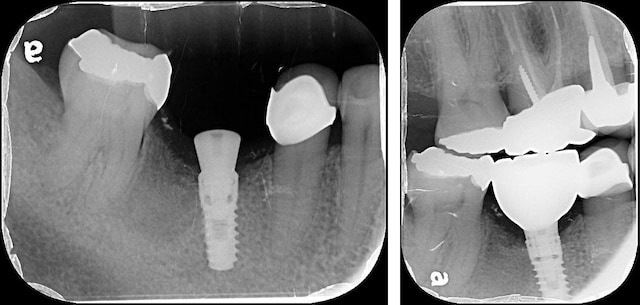 人工植牙手術-修補缺牙-全瓷冠-植牙假牙