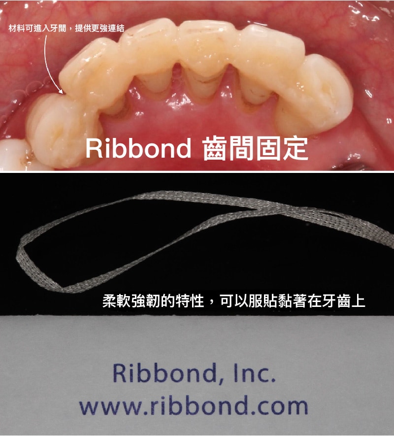 Ribbond-齒間固定材料-降低牙齒搖晃程度-齒間固定術