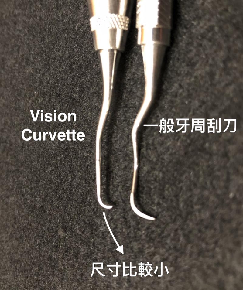 Vision Curvette牙周刮刀-尺寸為傳統牙周刮刀的一半-深入牙周囊袋-牙結石清創