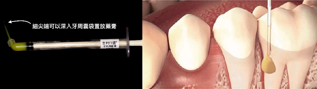 mapcare牙周病治療方案-Antimicrobial-牙周專用局部藥膏輔助清除細菌-牙周病治療第一階段