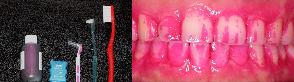 mapcare牙周病治療方案-Care-專人關心患者的牙菌斑控制-牙周病治療第一階段