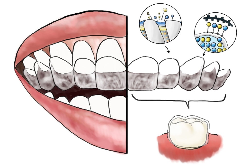 mapcare牙周病治療方案-牙周病治療第一階段-Care-牙周維護-客製化多功能牙托-氟托-修復牙齒敏感