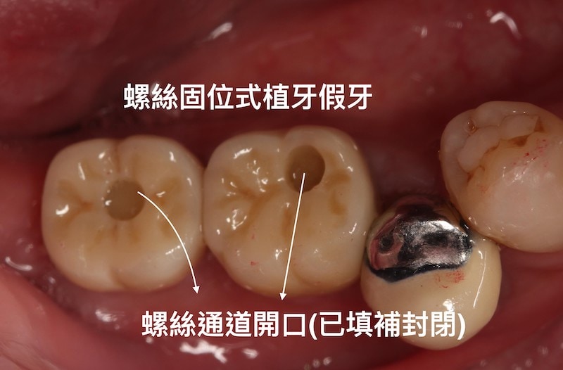 人工植牙-固定式植牙假分設計分類-螺絲固位式植牙假牙