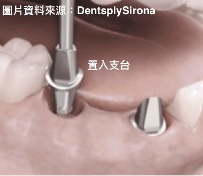 人工植牙-固定式植牙假分設計分類-黏著劑固位式-先鎖上支台