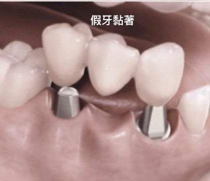 人工植牙-固定式植牙假分設計分類-黏著劑固位式-將假牙黏著在支台上