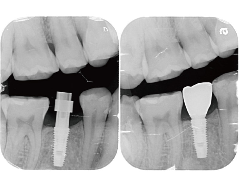 人工植牙假牙-安裝前後-X光照