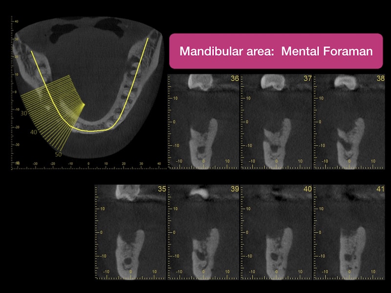 人工植牙手術前-利用電腦斷層分析植牙處骨頭條件-電腦斷層圖