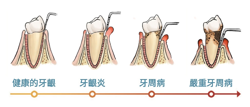 何謂牙周病-牙周病治療