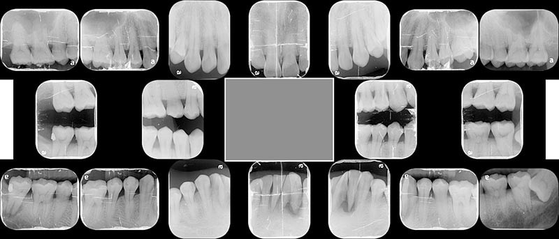 全口X光片-牙周病第一階段治療