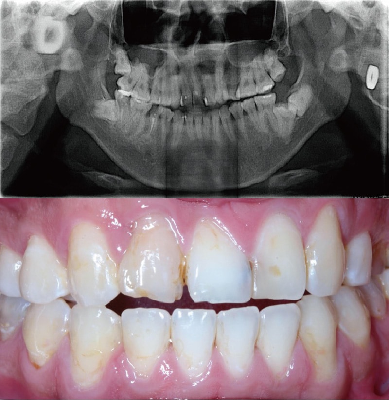 牙周病治療前-環口式X光片-口內檢查照