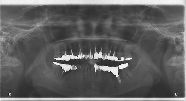 患者的全口X光片-可看出多顆假牙-多顆牙齒做根管治療