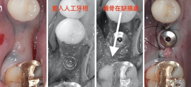 採人工植牙修補缺牙處-術前-置入人工牙根-植牙前補骨-手術完成