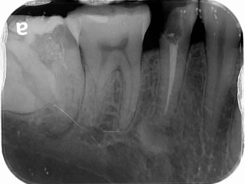 右下第二小臼齒-根管治療未修復-牙齒斷裂-X光片