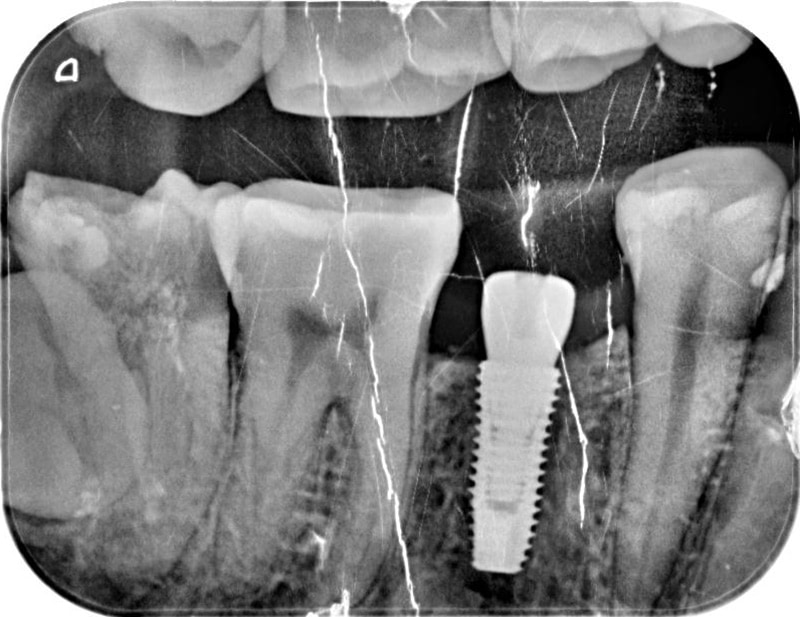 植牙手術後-X光照-植體穩定度良好