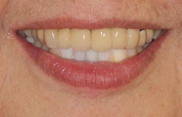 DSD數位微笑設計-治療過程中-先用臨時材料試戴模擬牙齒排列